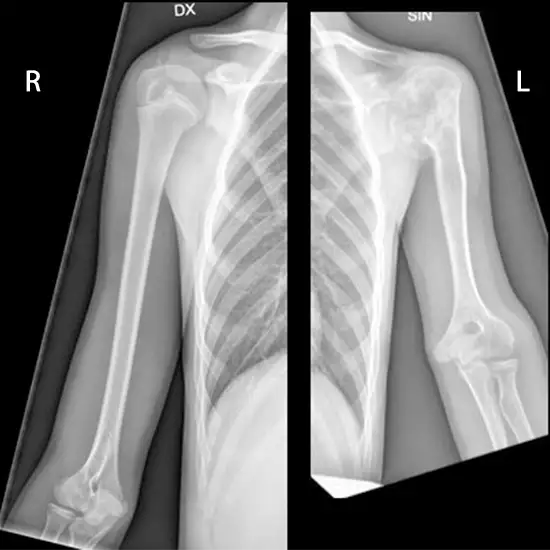 X-ray Both Arm AP View